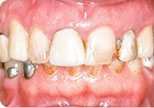 Before Dr. David Hazzouri Dental Patient #2