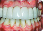 After - Dr. David Hazzouri Cosmetic Dental Patient #10