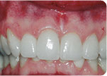 After - Dr. David Hazzouri Dental Cosmetic Dental Patient #5