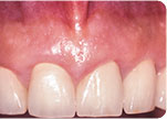 After - Dr. David Hazzouri Dental Cosmetic Dental Patient #6