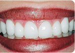 After - Dr. David Hazzouri Cosmetic Dental Patient #7