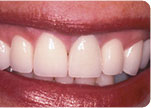 After - Dr. David Hazzouri Cosmetic Dental Patient #9