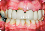 Before - Dr. David Hazzouri Cosmetic Dental Patient #10