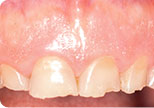 Before - Dr. David Hazzouri Dental Cosmetic Dental Patient #6