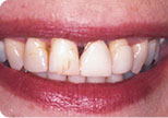 Before - Dr. David Hazzouri Cosmetic Dental Patient #9